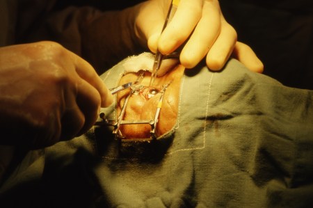 In 1981, surgery at the Amp Pipal Hospital was performed by Doctor Tom Hale of New York State. Hale also served in the Vietnam War as a doctor with the U.S. Army.